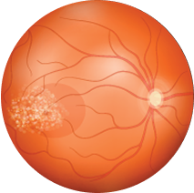 Eyeball effected by age related macular degeneration