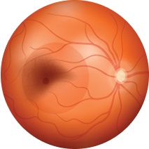 Wet age related macular degeneration eyeball drawing