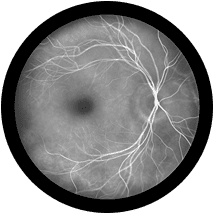 Image of a Fluorescein angiography picture of an eye